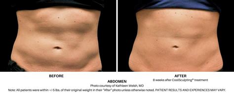 coolsculpting results after one treatment.